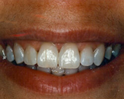 Cosmetic Bonding Before and After at Brookdale Dental Group in Bloomfeild, NJ.