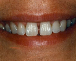 Cosmetic Bonding Before and After at Brookdale Dental Group in Bloomfeild, NJ.