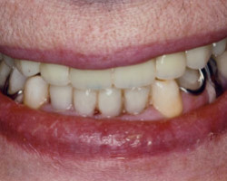 Cosmetic Bonding Before and After at Brookdale Dental Group in Bloomfeild, NJ.