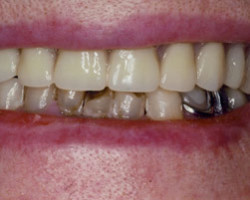 Cosmetic Bonding Before and After at Brookdale Dental Group in Bloomfeild, NJ.