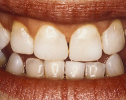 Cosmetic Bonding Before and After at Brookdale Dental Group in Bloomfeild, NJ.