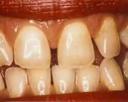 Cosmetic Bonding Before and After at Brookdale Dental Group in Bloomfeild, NJ.