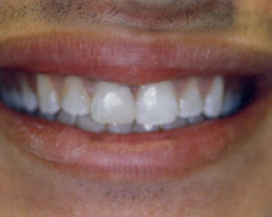 Cosmetic Bonding Before and After at Brookdale Dental Group in Bloomfeild, NJ.