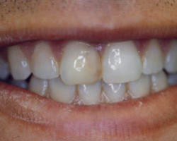 Cosmetic Bonding Before and After at Brookdale Dental Group in Bloomfeild, NJ.