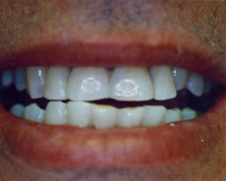 Cosmetic Bonding Before and After at Brookdale Dental Group in Bloomfeild, NJ.