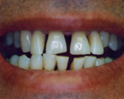 Cosmetic Bonding Before and After at Brookdale Dental Group in Bloomfeild, NJ.