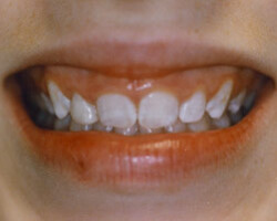 Cosmetic Bonding Before and After at Brookdale Dental Group in Bloomfeild, NJ.