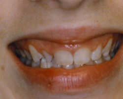 Cosmetic Bonding Before and After at Brookdale Dental Group in Bloomfeild, NJ.