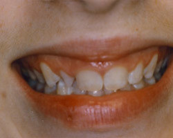 Cosmetic Bonding Before and After at Brookdale Dental Group in Bloomfeild, NJ.