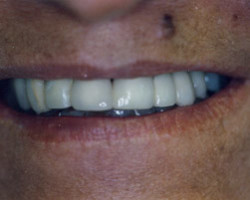 Cosmetic Bonding Before and After at Brookdale Dental Group in Bloomfeild, NJ.