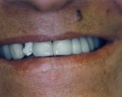 Cosmetic Bonding Before and After at Brookdale Dental Group in Bloomfeild, NJ.