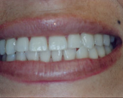 Cosmetic Bonding Before and After at Brookdale Dental Group in Bloomfeild, NJ.