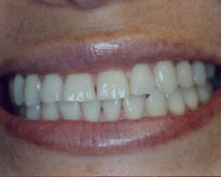 Cosmetic Bonding Before and After at Brookdale Dental Group in Bloomfeild, NJ.
