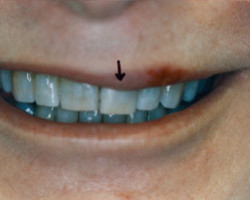 Cosmetic Bonding Before and After at Brookdale Dental Group in Bloomfeild, NJ.