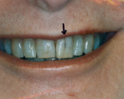 Cosmetic Bonding Before and After at Brookdale Dental Group in Bloomfeild, NJ.