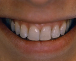 Cosmetic Bonding Before and After at Brookdale Dental Group in Bloomfeild, NJ.