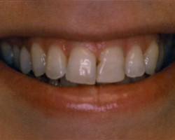 Cosmetic Bonding Before and After at Brookdale Dental Group in Bloomfeild, NJ.