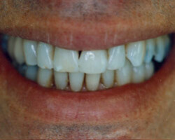 Cosmetic Bonding Before and After at Brookdale Dental Group in Bloomfeild, NJ.