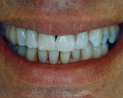 Cosmetic Bonding Before and After at Brookdale Dental Group in Bloomfeild, NJ.