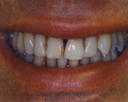 Cosmetic Bonding Before and After at Brookdale Dental Group in Bloomfeild, NJ.