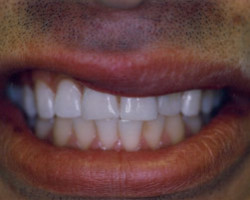 Cosmetic Bonding Before and After at Brookdale Dental Group in Bloomfeild, NJ.