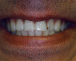 Cosmetic Bonding Before and After at Brookdale Dental Group in Bloomfeild, NJ.