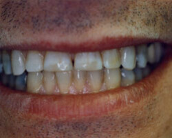 Cosmetic Bonding Before and After at Brookdale Dental Group in Bloomfeild, NJ.