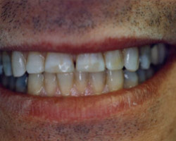 Cosmetic Bonding Before and After at Brookdale Dental Group in Bloomfeild, NJ.