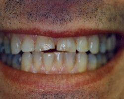 Cosmetic Bonding Before and After at Brookdale Dental Group in Bloomfeild, NJ.
