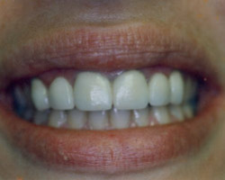 Dental Bridge Work Before and After at Brookdale Dental Group in Bloomfeild, NJ.