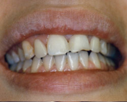 Dental Bridge Work Before and After at Brookdale Dental Group in Bloomfeild, NJ.