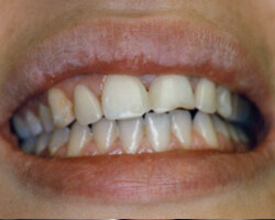 Dental Bridge Work Before and After at Brookdale Dental Group in Bloomfeild, NJ.