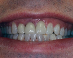 Dental Bridge Work Before and After at Brookdale Dental Group in Bloomfeild, NJ.