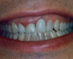 Dental Bridge Work Before and After at Brookdale Dental Group in Bloomfeild, NJ.