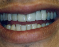 Dental Bridge Work Before and After at Brookdale Dental Group in Bloomfeild, NJ.