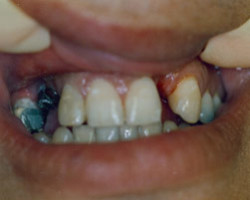 Dental Bridge Work Before and After at Brookdale Dental Group in Bloomfeild, NJ.