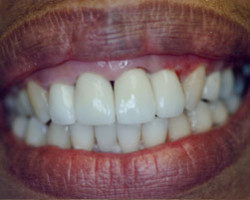 Dental Crowns Before and After at Brookdale Dental Group in Bloomfeild, NJ.