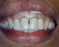 Dental Crowns Before and After at Brookdale Dental Group in Bloomfeild, NJ.