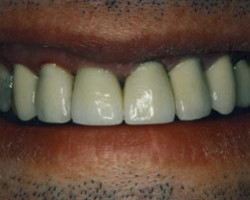 Dental Crowns Before and After at Brookdale Dental Group in Bloomfeild, NJ.