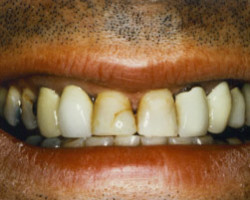 Dental Crowns Before and After at Brookdale Dental Group in Bloomfeild, NJ.