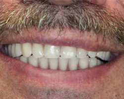 Dentures Before and After at Brookdale Dental Group in Bloomfeild, NJ.