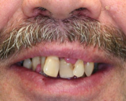 Dentures Before and After at Brookdale Dental Group in Bloomfeild, NJ.