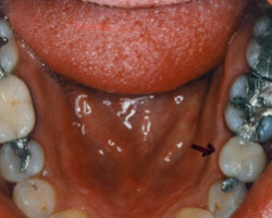 Tooth Colored Fittings Before and After at Brookdale Dental Group in Bloomfeild, NJ.