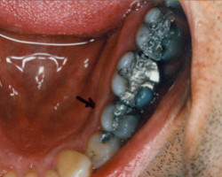Tooth Colored Fittings Before and After at Brookdale Dental Group in Bloomfeild, NJ.