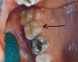 Tooth Colored Fittings Before and After at Brookdale Dental Group in Bloomfeild, NJ.