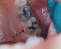 Tooth Colored Fittings Before and After at Brookdale Dental Group in Bloomfeild, NJ.