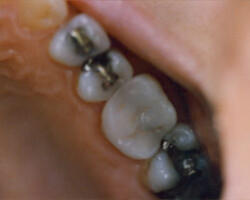 Tooth Colored Fittings Before and After at Brookdale Dental Group in Bloomfeild, NJ.