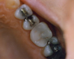 Tooth Colored Fittings Before and After at Brookdale Dental Group in Bloomfeild, NJ.