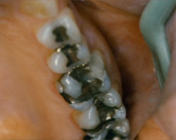 Tooth Colored Fittings Before and After at Brookdale Dental Group in Bloomfeild, NJ.