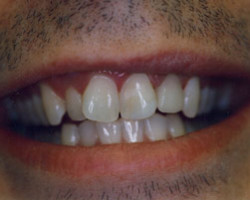 Tooth Colored Fittings Before and After at Brookdale Dental Group in Bloomfeild, NJ.